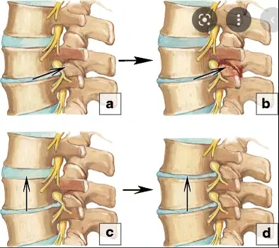 Spinal Degenerative Joint Disease