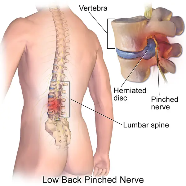is inversion table good for pinched nerve?